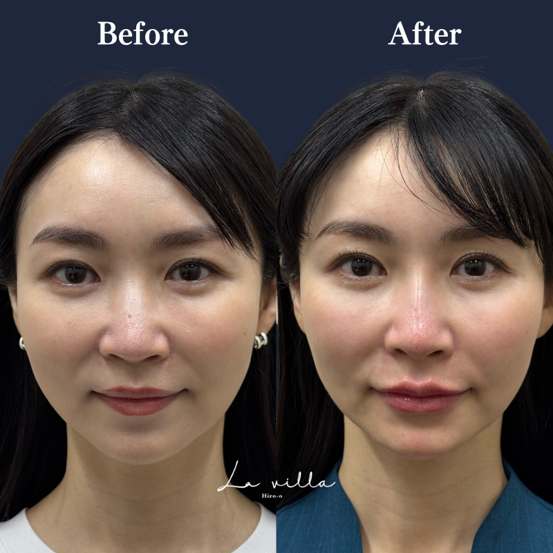 唇・鼻ヒアルロン酸  No.397