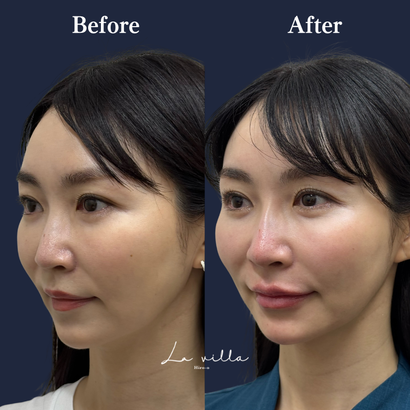 唇・鼻ヒアルロン酸  No.397