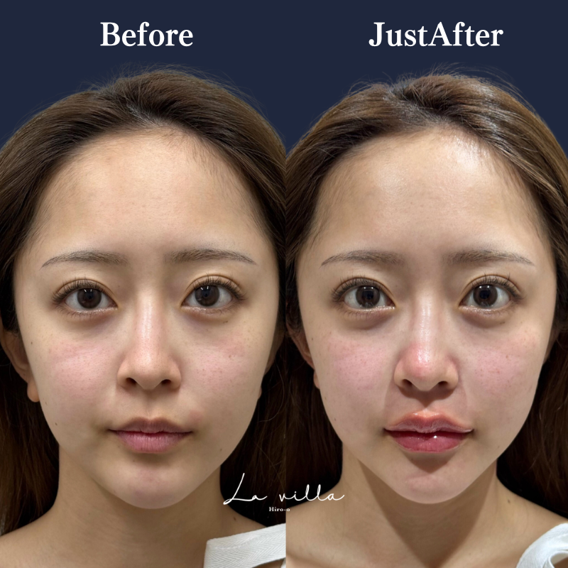 スーパーハイフRT +リヴァイブ＋唇ボライト No.398