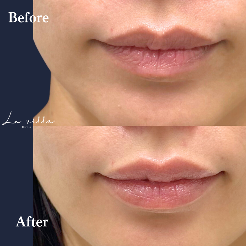 唇ボライト No.399