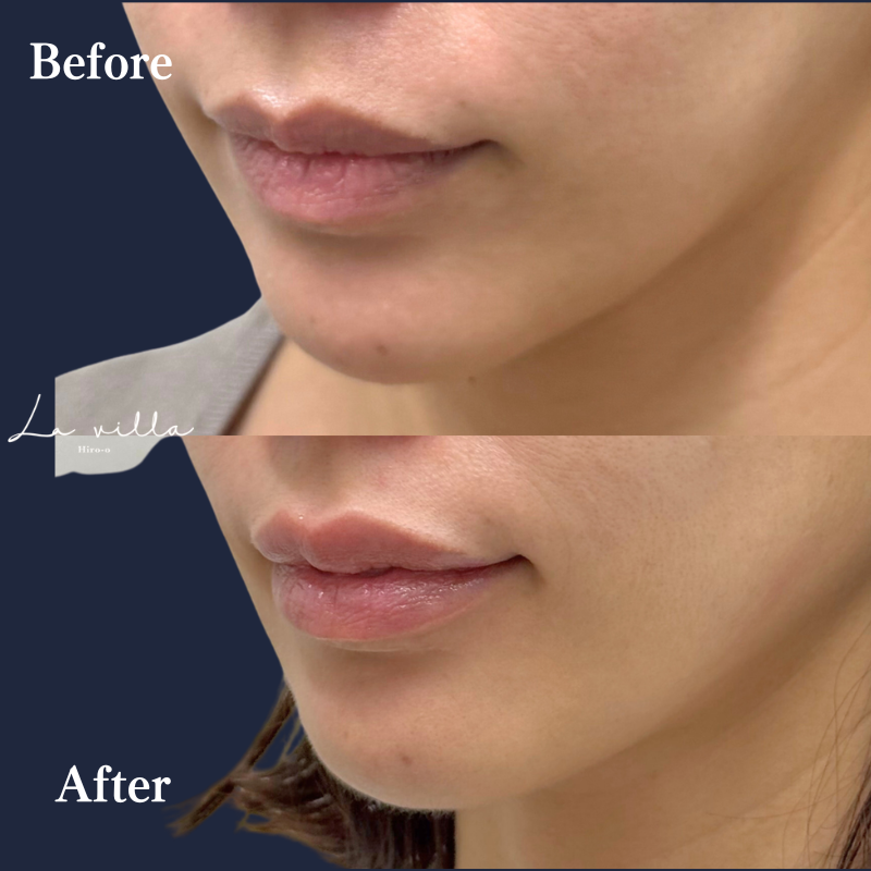 唇ボライト No.399