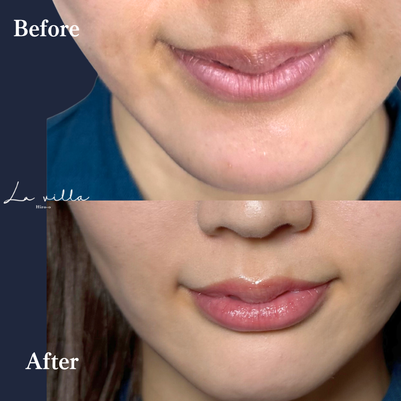 唇ボライト No.400