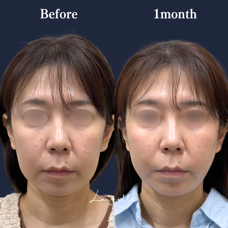 糸リフト＋ショッピングリフト No.401