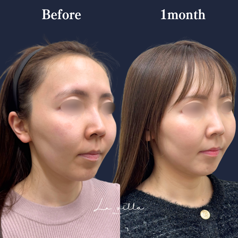 糸リフト＋ショッピングリフト No.402