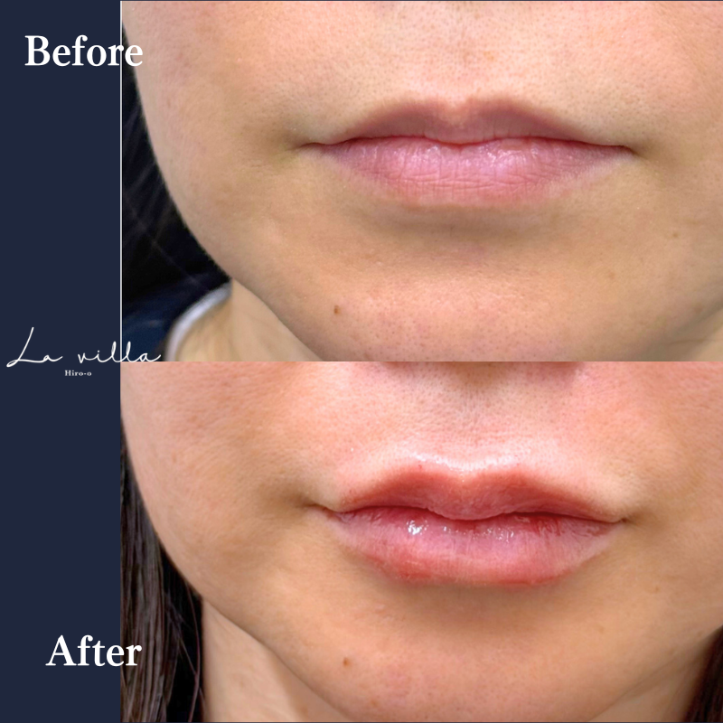 唇ヒアルロン酸  No.406