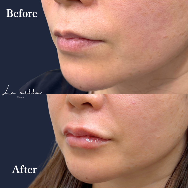 唇ヒアルロン酸  No.406