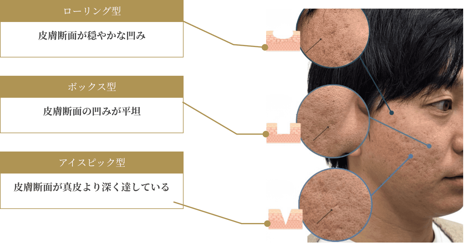 ニキビ跡の3タイプ（ローリング型・ボックス型・アイスピック型）