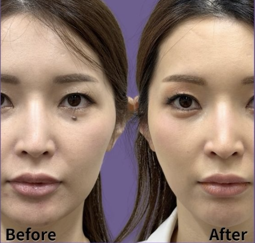 皮膚のタイトニング、リフトアップ効果
