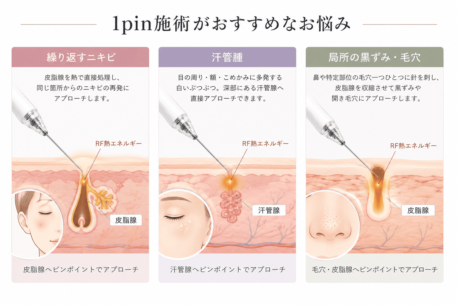 1pin施術がおすすめなお悩み 繰り返すニキビ・汗管腫・局所の黒ずみ・毛穴へRF熱エネルギーでピンポイントにアプローチ