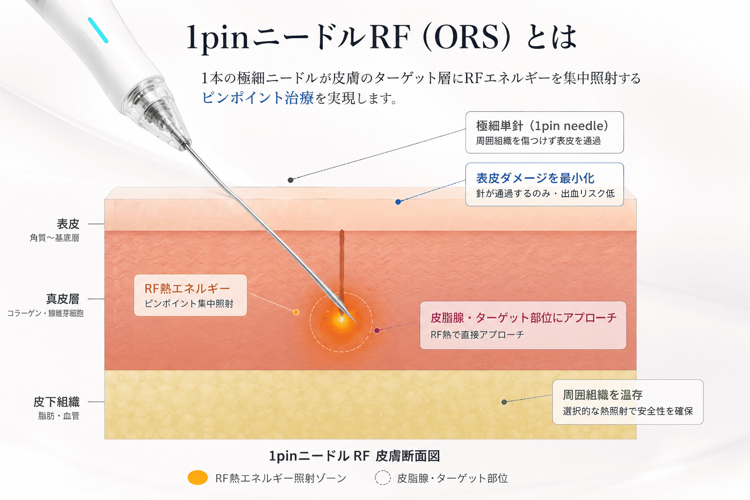 1pinニードルRF（ORS）とは 1本の極細ニードルが皮膚のターゲット層にRFエネルギーを集中照射するピンポイント治療 皮膚断面図