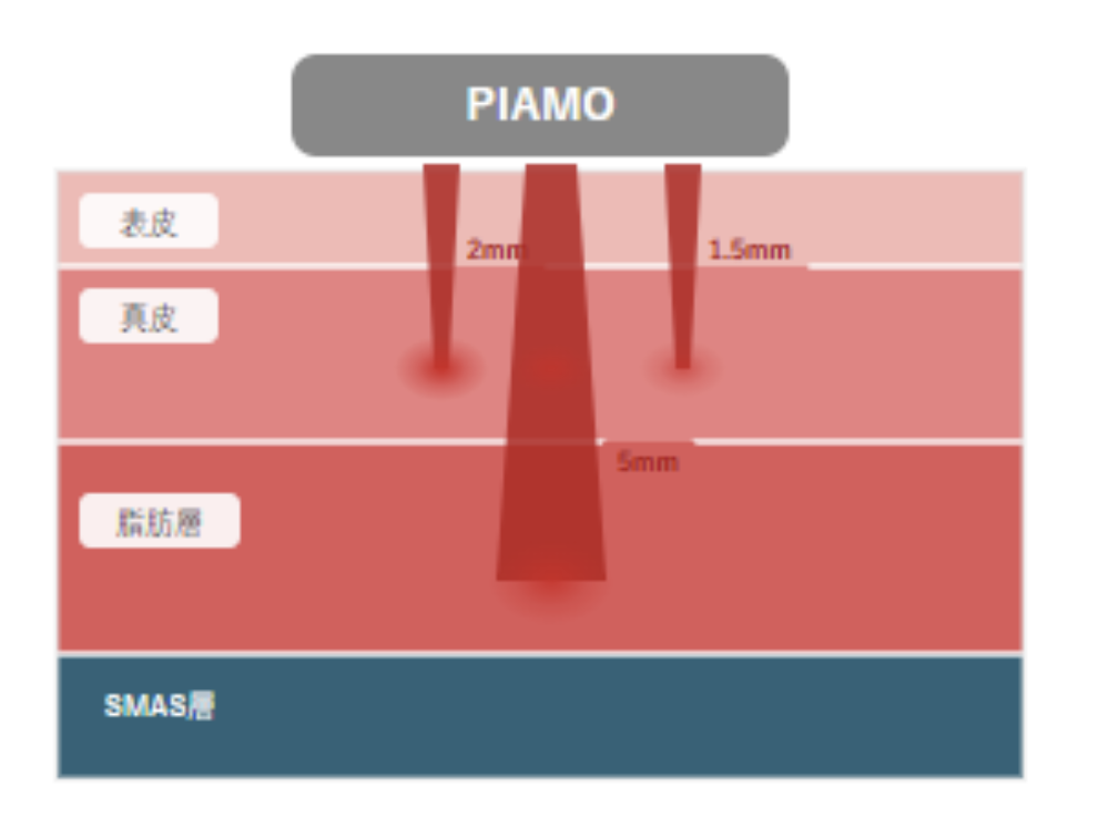 PIAMO治療で期待できる効果