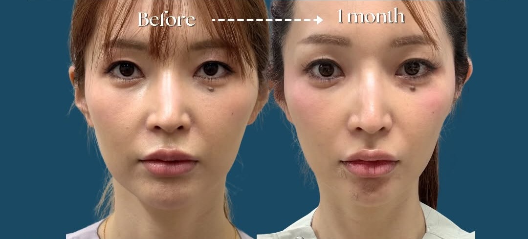 CASE 02 Before / Just After