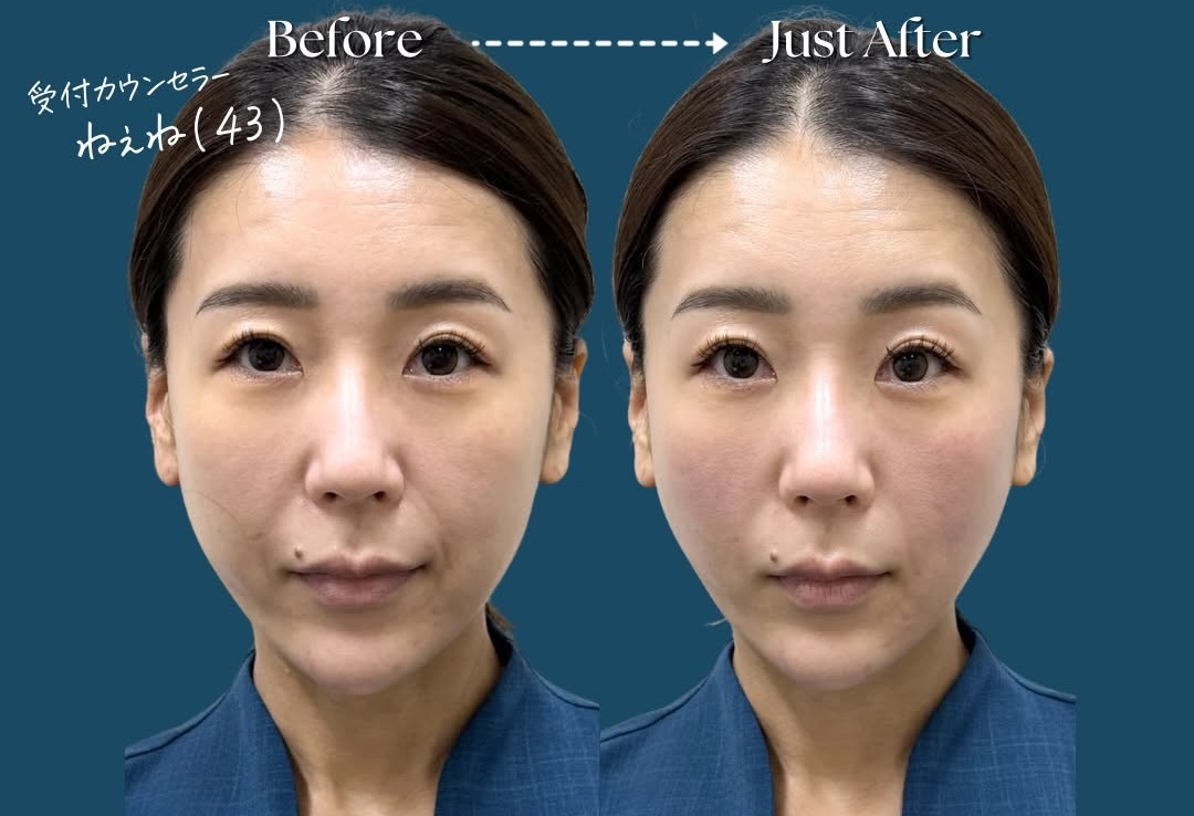 CASE 03 Before / Just After