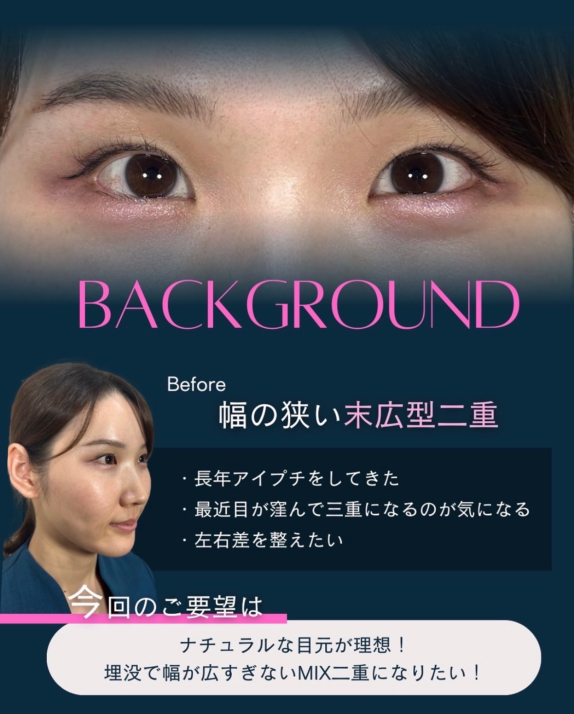 当院スタッフの埋没経過 2