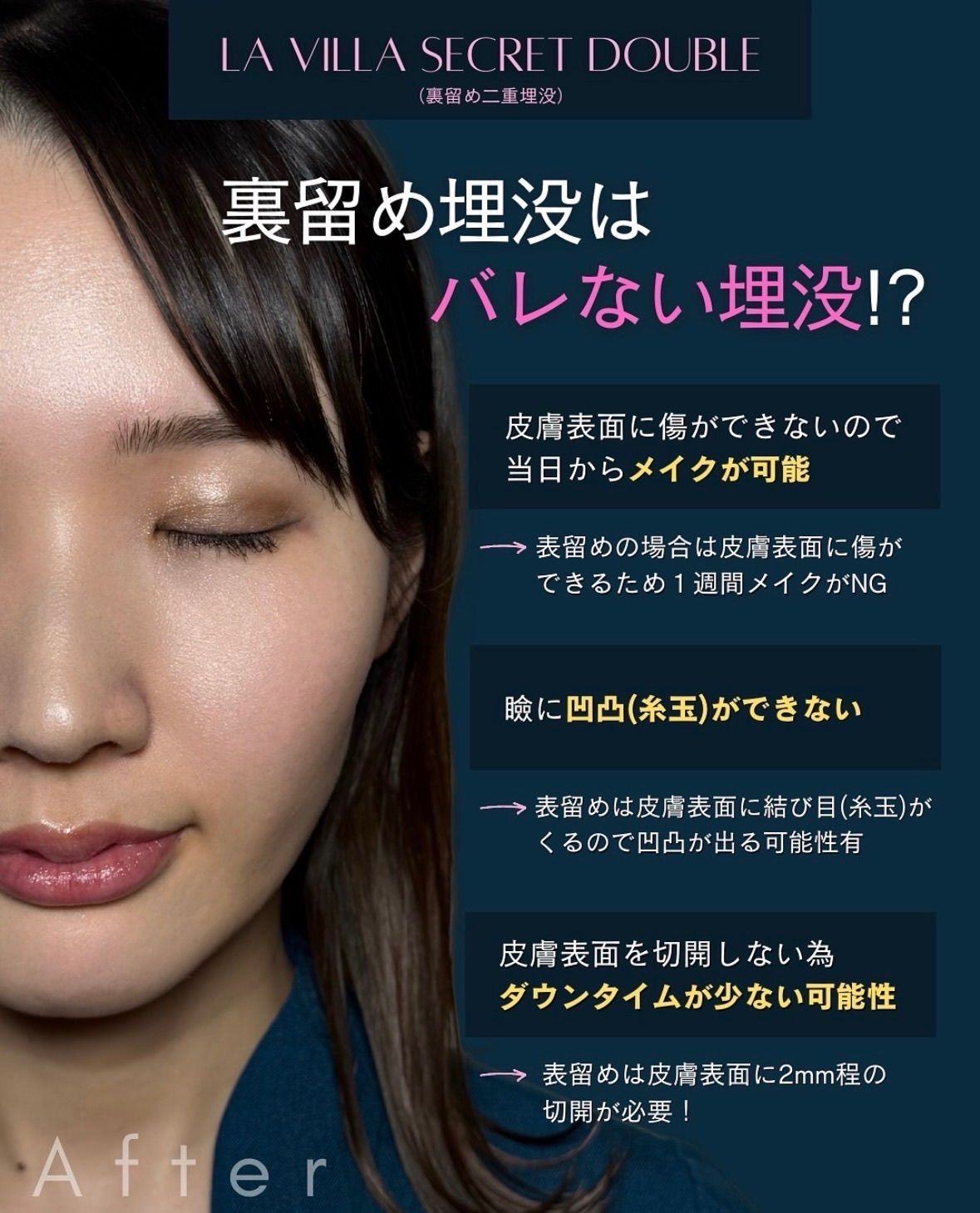 当院スタッフの埋没経過 4