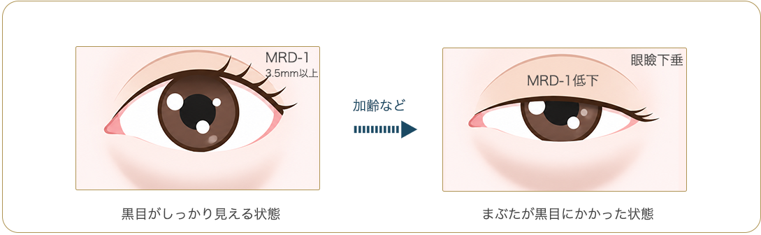 眼瞼下垂の症状