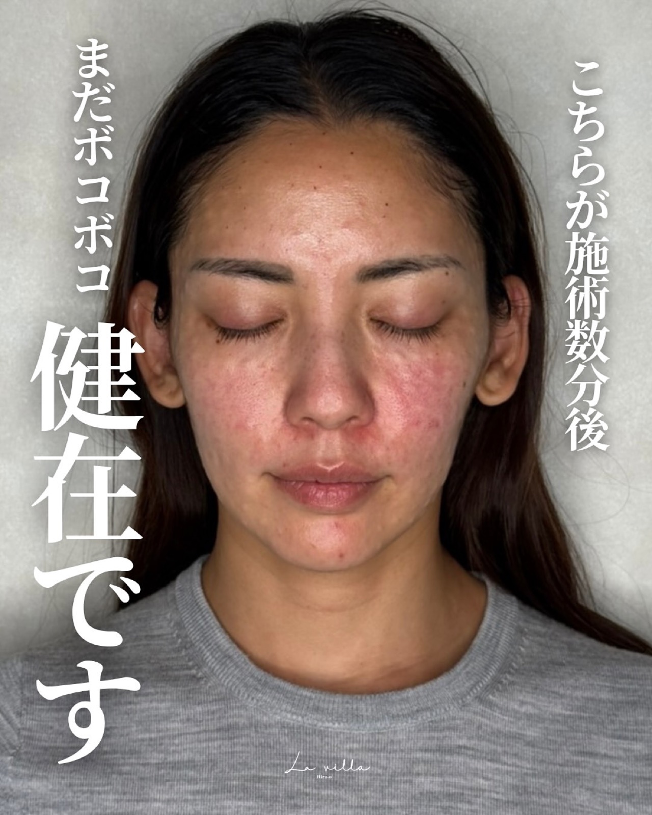 ダウンタイムの経過