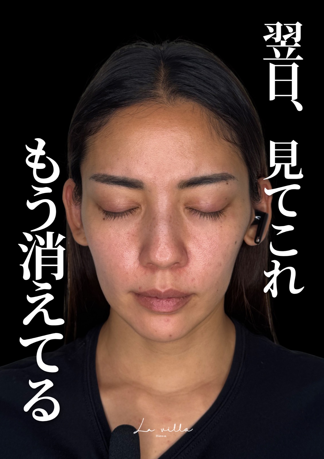 ダウンタイムの経過