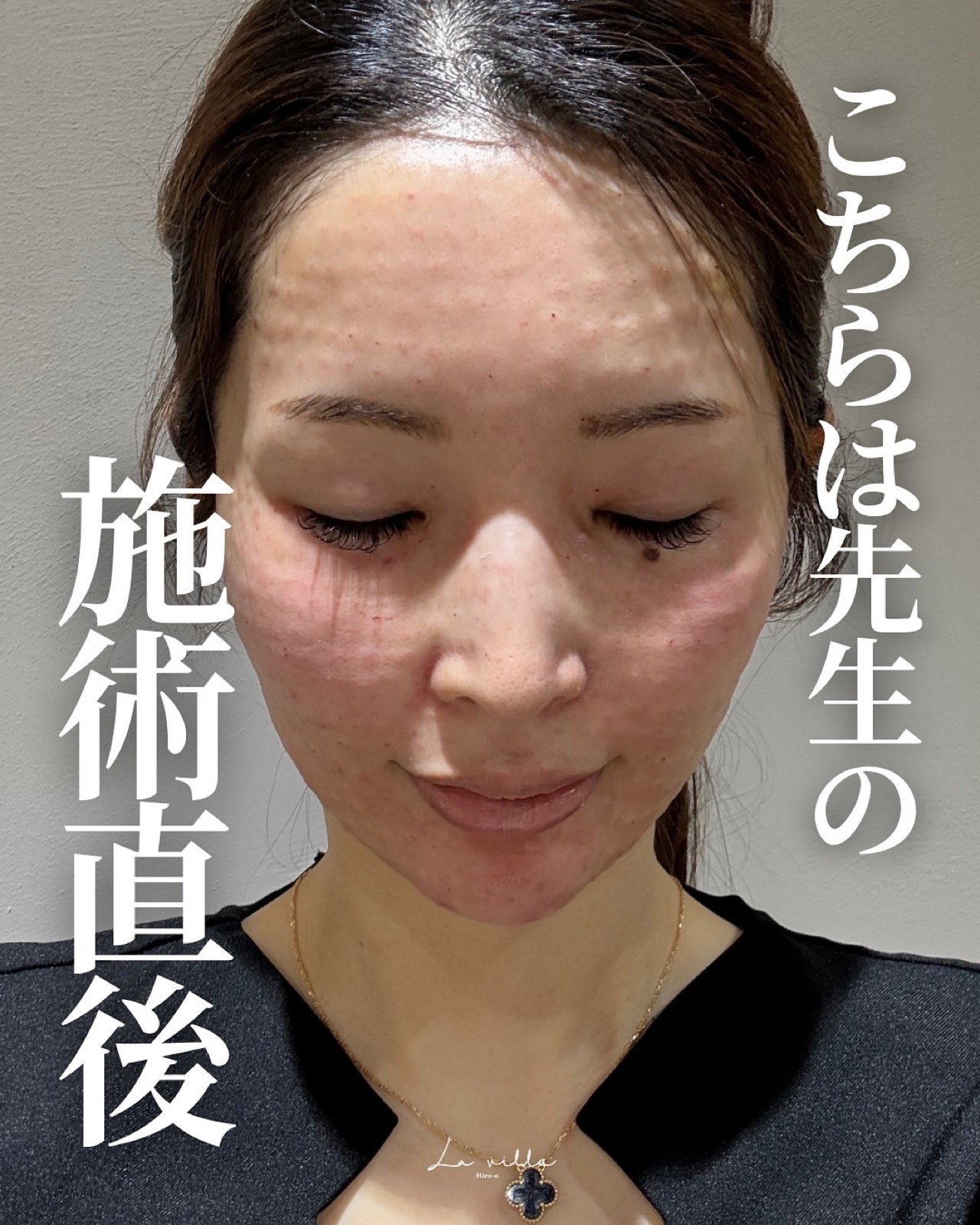 ダウンタイムの経過
