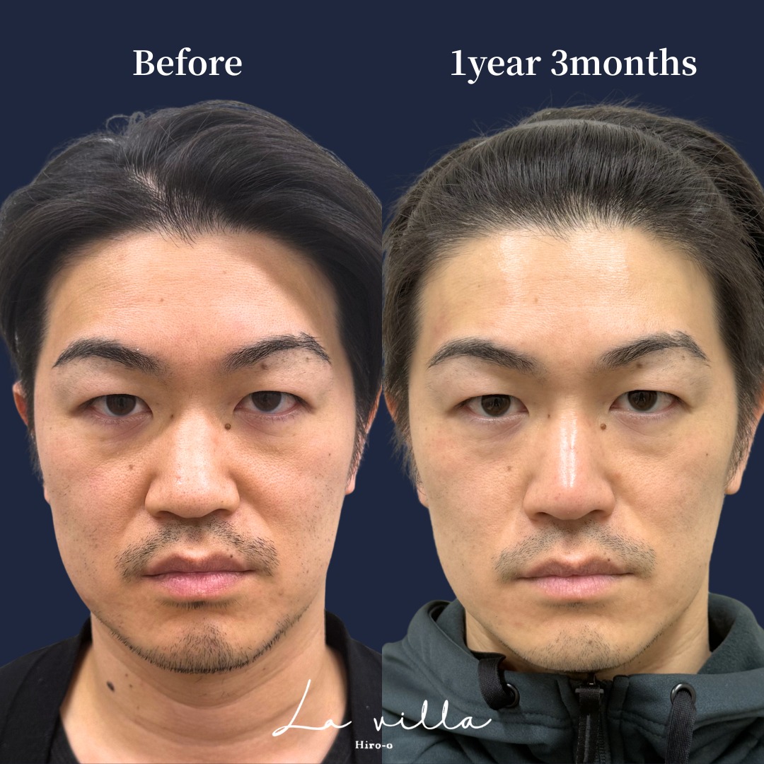 カシミアスキンの症例 Before / After